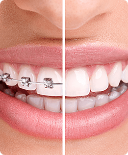 SE Calgary Braces | Forest Lane Dental Clinic | Family & General Dentists | SE Calgary