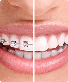 Braces | Forest Lane Dental Clinic | Family & General Dentists | SE Calgary