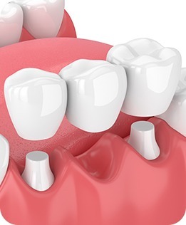 Dental Bridges | Forest Lane Dental Clinic | Family & General Dentists | SE Calgary