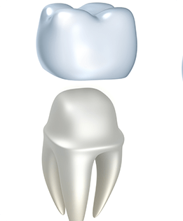 Dental Crowns | Forest Lane Dental Clinic | Family & General Dentists | SE Calgary