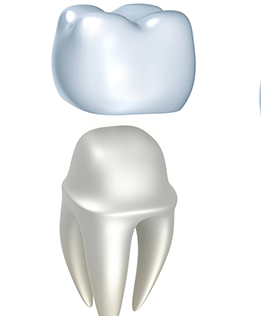 Calgary Dental Crowns | Forest Lane Dental Clinic | Family & General Dentists | SE Calgary