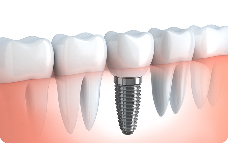 Dental Implants | Forest Lane Dental Clinic | Family & General Dentists | SE Calgary