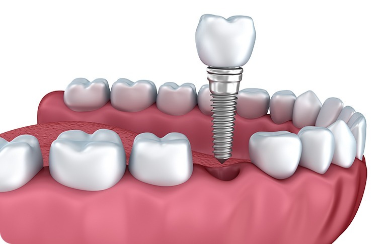 Dental Implants | Forest Lane Dental Clinic | Family & General Dentists | SE Calgary