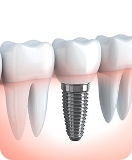 Dental Implants | Forest Lane Dental Clinic | Family & General Dentists | SE Calgary