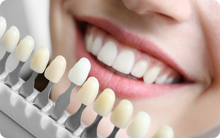 Porcelain Veneers Calgary | Forest Lane Dental Clinic | Family & General Dentists | SE Calgary