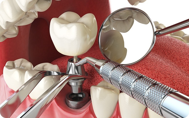 Dental Implants | Forest Lane Dental Clinic | Family & General Dentists | SE Calgary