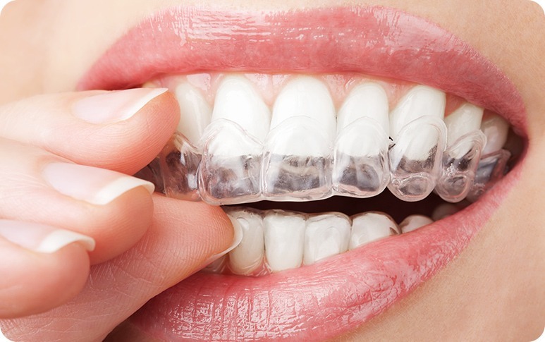 Calgary Invisalign® | Forest Lane Dental Clinic | Family & General Dentists | SE Calgary