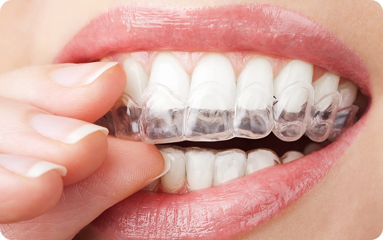 Invisalign® | Forest Lane Dental Clinic | Family & General Dentists | SE Calgary