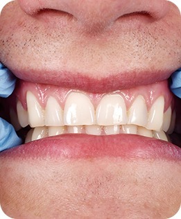 Periodontal Disease in Calgary | Forest Lane Dental Clinic | Family & General Dentists | SE Calgary