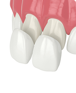 Calgary Porcelain Veneers | Forest Lane Dental Clinic | Family & General Dentists | SE Calgary