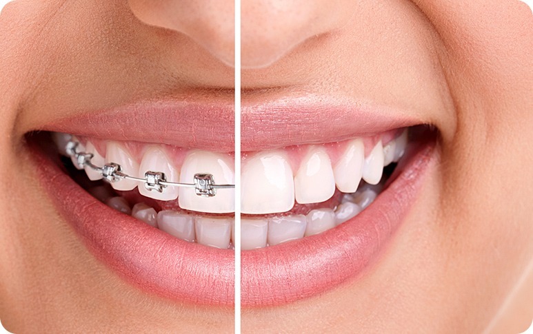 Regular Braces | Forest Lane Dental Clinic | Family & General Dentists | SE Calgary