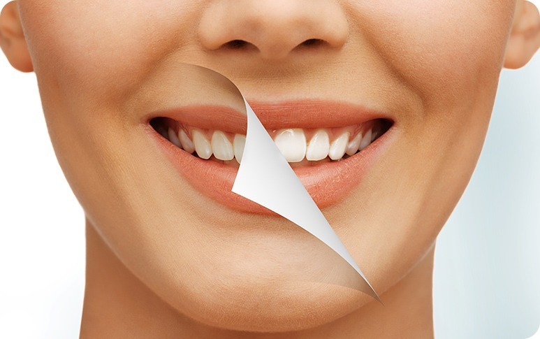 Teeth Whitening | Forest Lane Dental Clinic | Family & General Dentists | SE Calgary