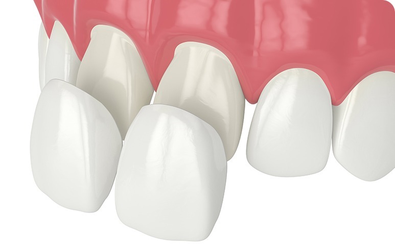 Porcelain Veneers | Forest Lane Dental Clinic | Family & General Dentists | SE Calgary