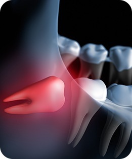 Calgary Wisdom Teeth Extractions | Forest Lane Dental Clinic | Family & General Dentists | SE Calgary