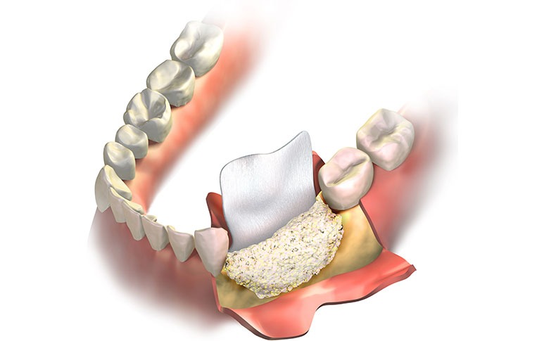 Bone Grafting | Forest Lane Dental Clinic | Family & General Dentists | SE Calgary