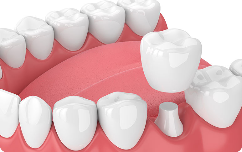 Dental Crowns | Forest Lane Dental Clinic | Family & General Dentists | SE Calgary