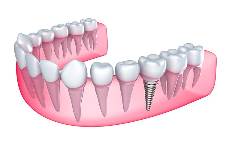 Dental Implants | Forest Lane Dental Clinic | Family & General Dentists