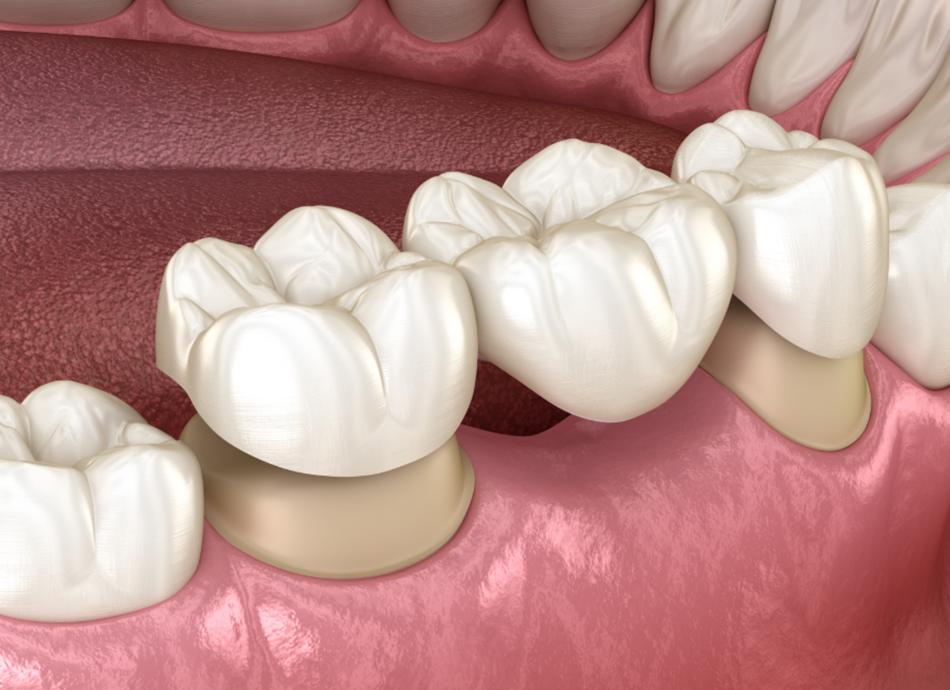 Dental Bridges SE Calgary