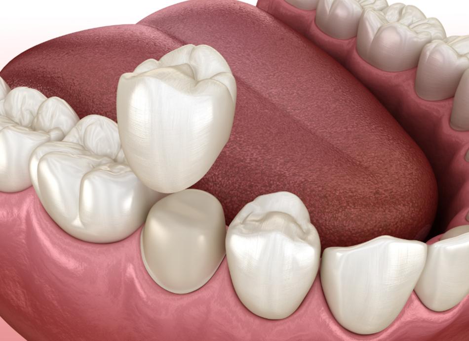Calgary Dental Crowns