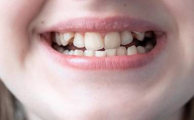 Calgary Wisdom Teeth Extractions | Forest Lane Dental Clinic | Family & General Dentists | SE Calgary