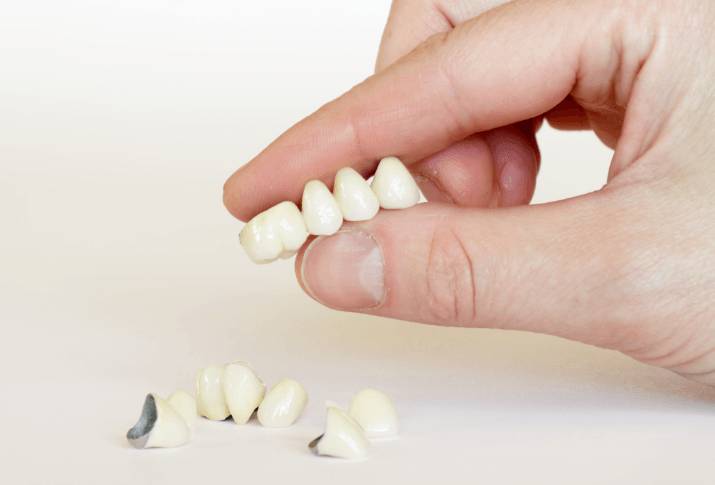 Dental Bridges | Forest Lane Dental Clinic | Family & General Dentists | SE Calgary