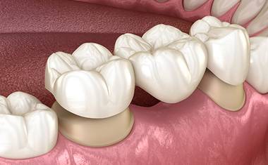 Calgary Dental Bridges | Forest Lane Dental Clinic | Family & General Dentists | SE Calgary