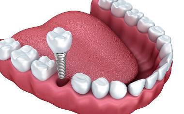Calgary Dental Implants | Forest Lane Dental Clinic | Family & General Dentists | SE Calgary