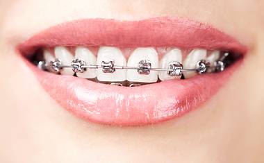 SE Calgary Braces | Forest Lane Dental Clinic | Family & General Dentists | SE Calgary