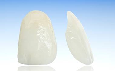 Calgary Porcelain Veneers | Forest Lane Dental Clinic | Family & General Dentists | SE Calgary