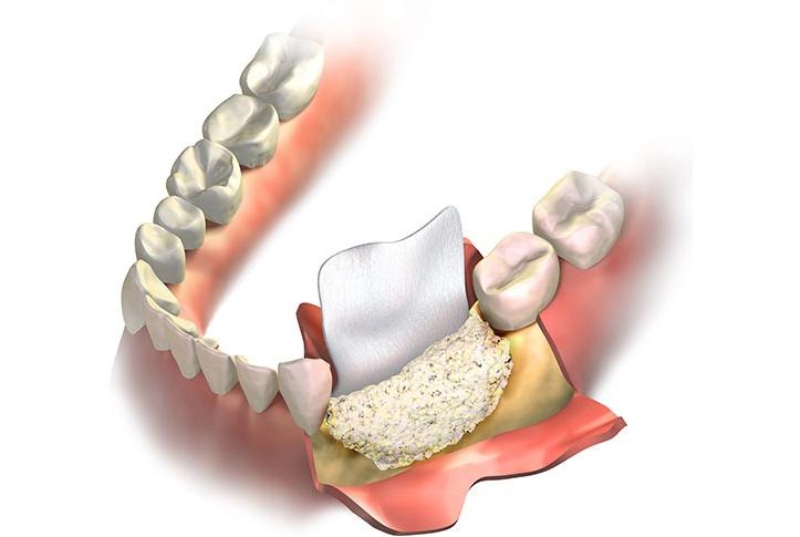 Bone Grafting | Forest Lane Dental Clinic | Family & General Dentists | SE Calgary