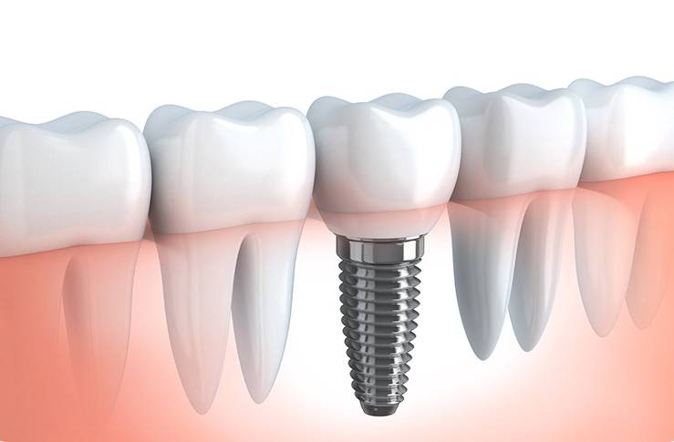 Calgary Dental Implants | Forest Lane Dental Clinic | Family & General Dentists | SE Calgary