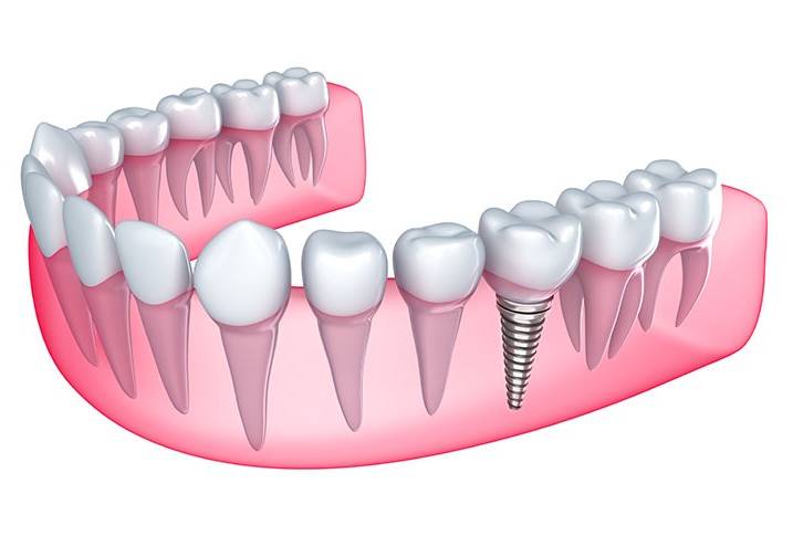 Dental Implants | Forest Lane Dental Clinic | Family & General Dentists
