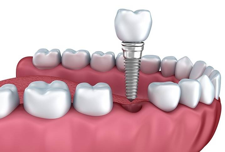 Dental Implants | Forest Lane Dental Clinic | Family & General Dentists | SE Calgary