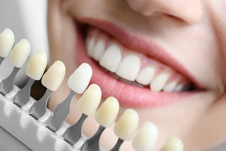 Porcelain Veneers Calgary | Forest Lane Dental Clinic | Family & General Dentists | SE Calgary