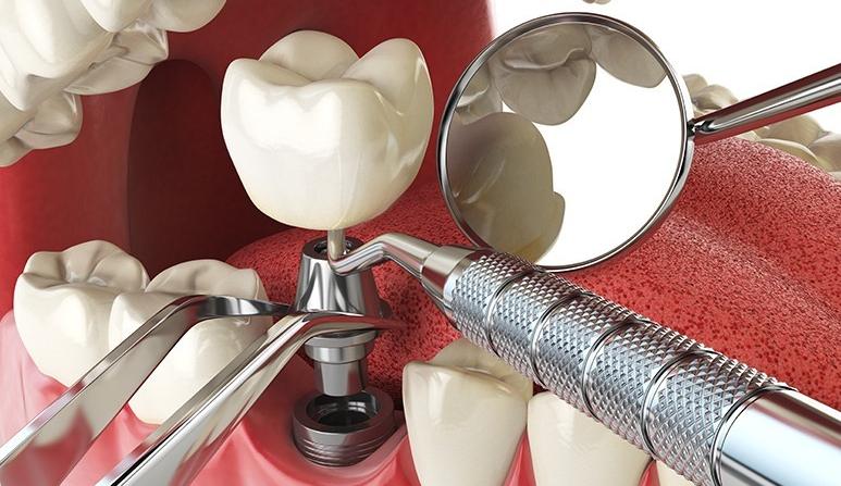 Dental Implants | Forest Lane Dental Clinic | Family & General Dentists | SE Calgary