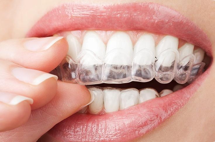 Calgary Invisalign® | Forest Lane Dental Clinic | Family & General Dentists | SE Calgary