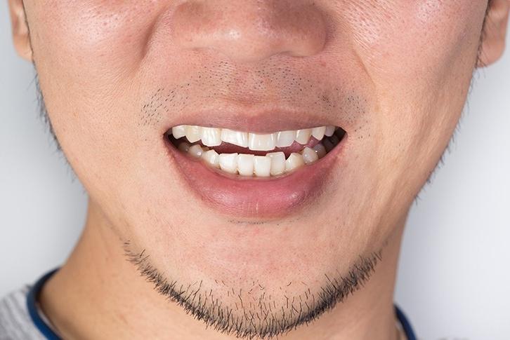 Conditions Invisalign® Can Treat | Forest Lane Dental Clinic | Family & General Dentists | SE Calgary