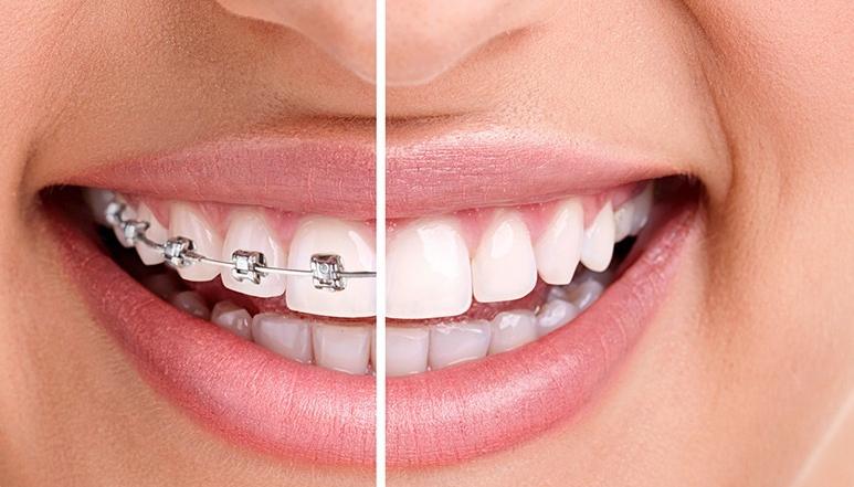 Calgary Braces | Forest Lane Dental Clinic | Family & General Dentists | SE Calgary