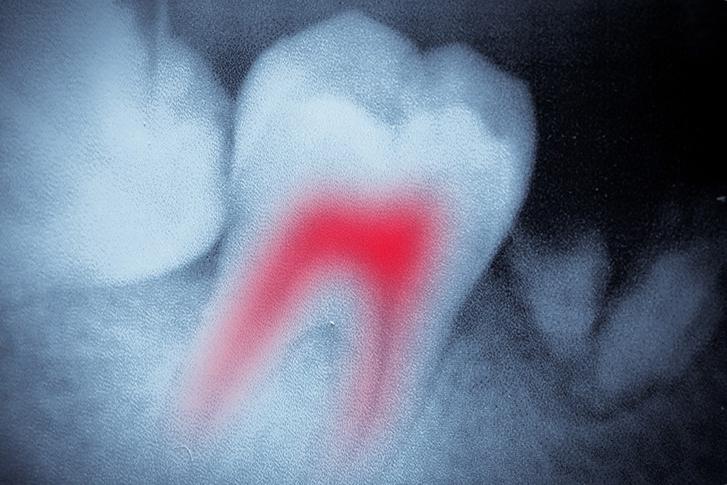 Root Canal Therapy | Forest Lane Dental Clinic | Family & General Dentists | SE Calgary