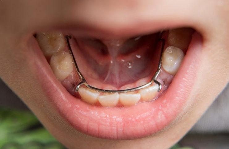 Space Maintainers | Forest Lane Dental Clinic | Family & General Dentists | SE Calgary