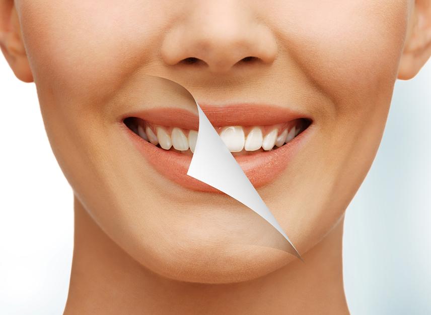 Teeth Whitening Calgary | Forest Lane Dental Clinic | Family & General Dentists | SE Calgary